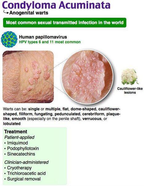 Condylomes acuminés