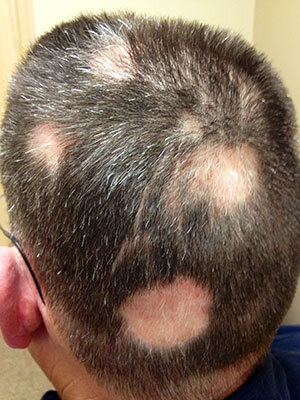 Teigne du cuir chevelu