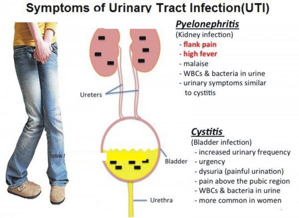 Symptômes d'infection urinaire